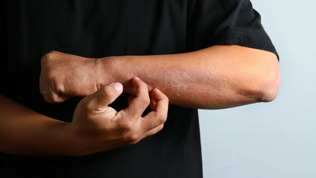 تشدید روند اگزما 