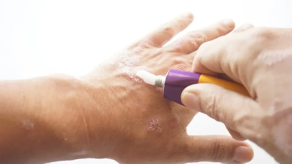 درمان پسوریازیس با دارو