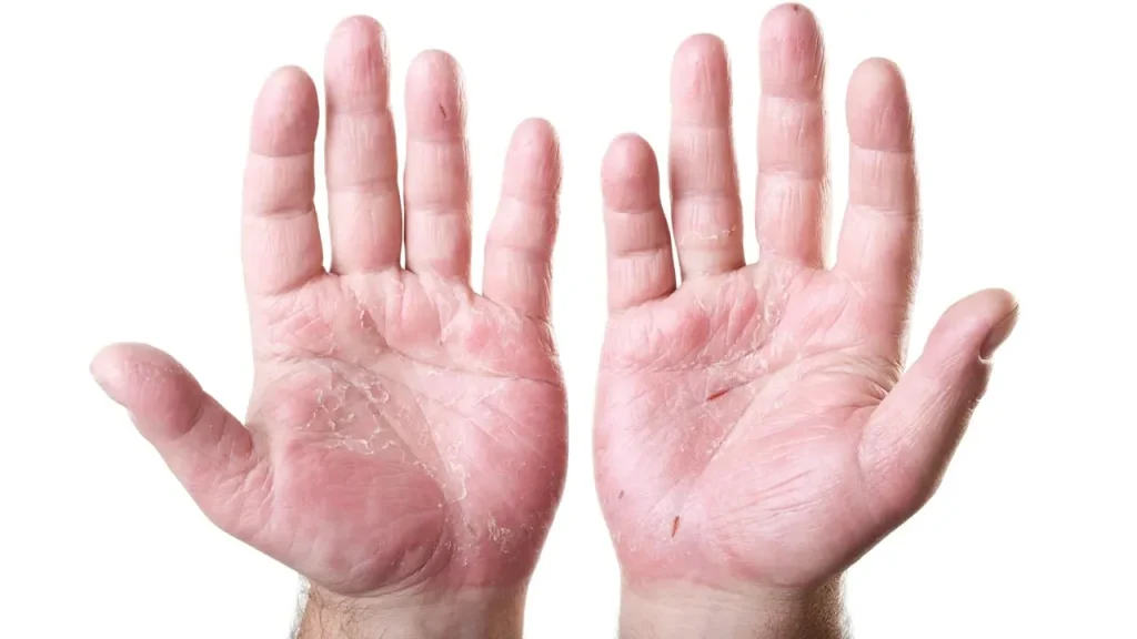 دلیل به وجود آمدن پسوریازیس چیست