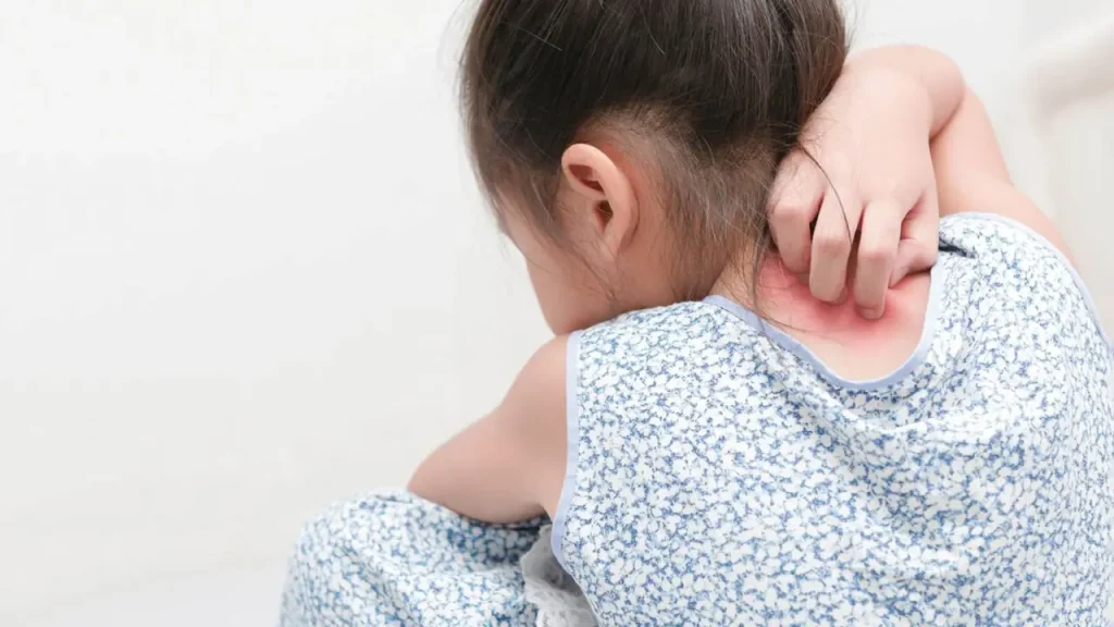 پسوریازیس خالدار