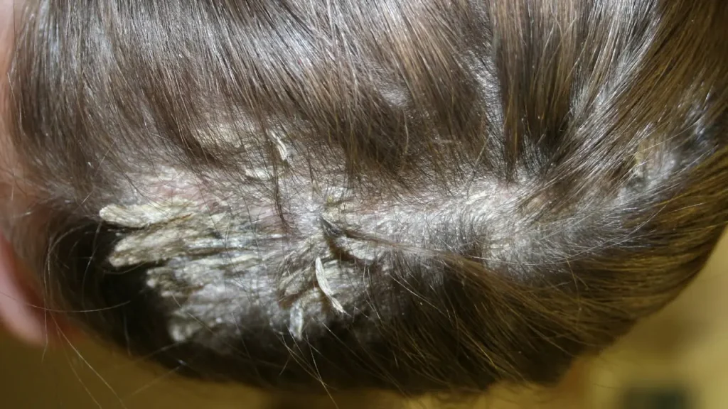 پسوریازیس پوست سر