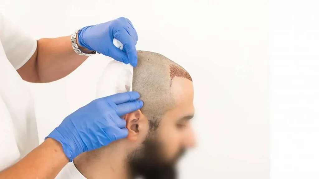 شستشوی مو بعد از کاشت مو