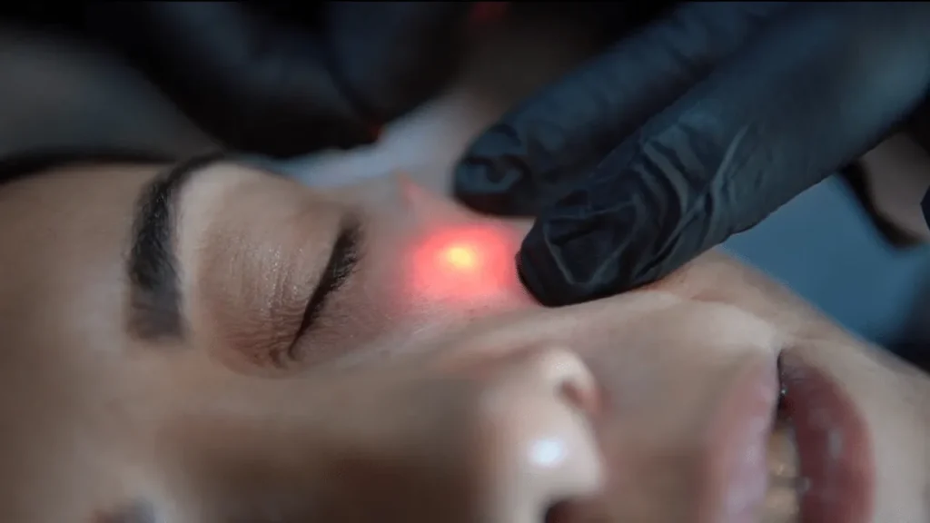 لیزر اندولیفت