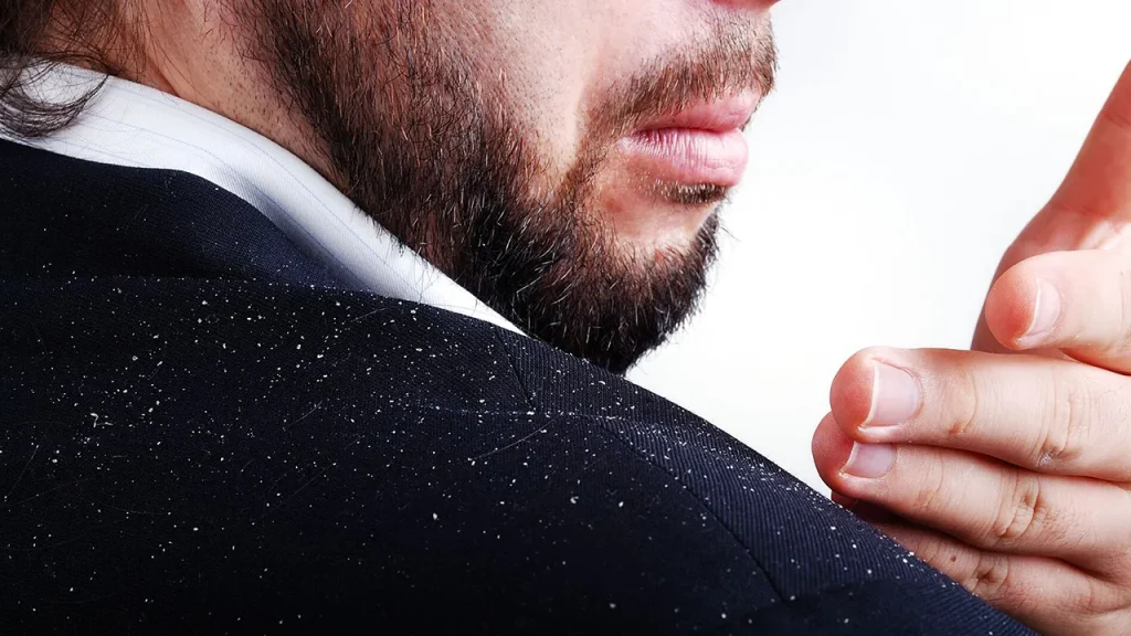 تاثیر رزماری بر روی شوره سر