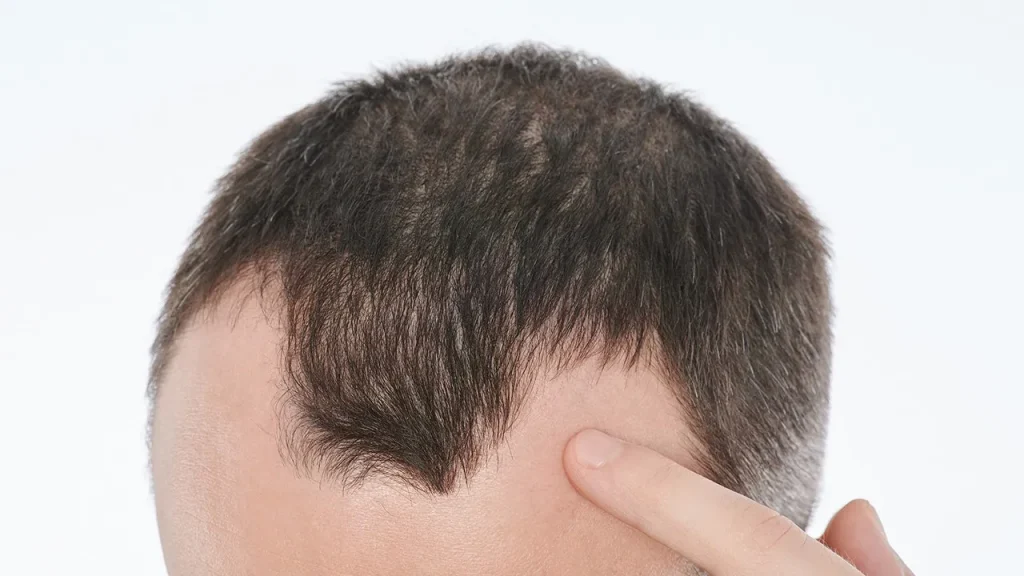 ریزش مو در آقایان