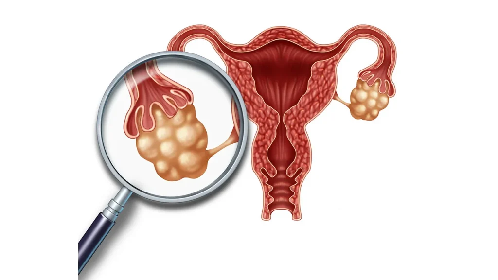 سندرم تخمدان پلی‌کیستیک