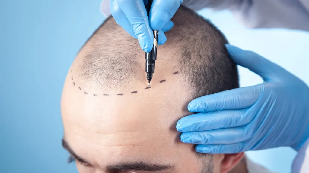 مقایسه میکرواسکالپ با کاشت