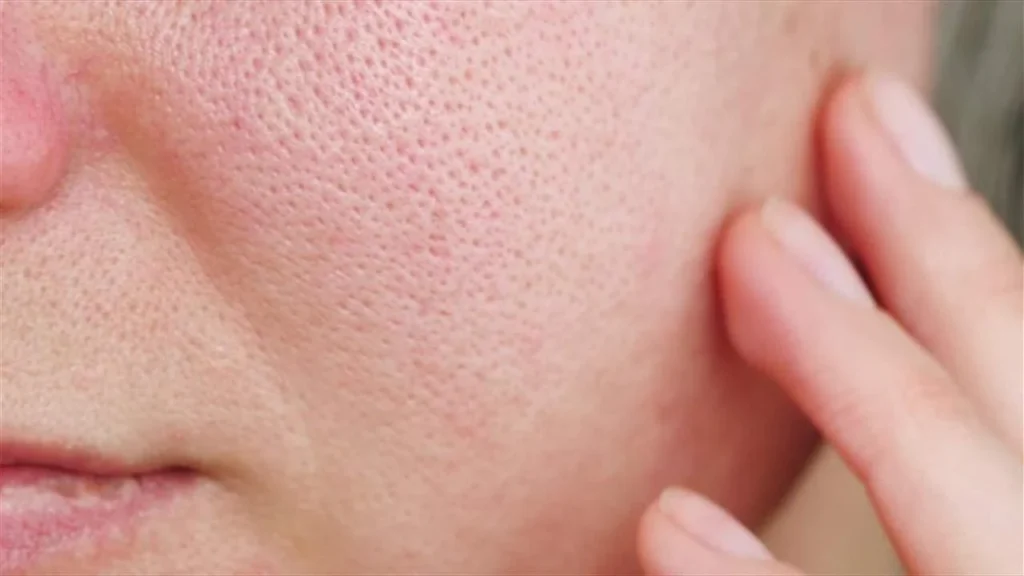 تاثیر ترکیبات تحریک کننده بر روی پوست