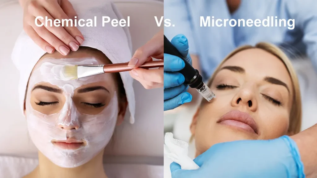 میکرونیدلینگ یا اسیدتراپی