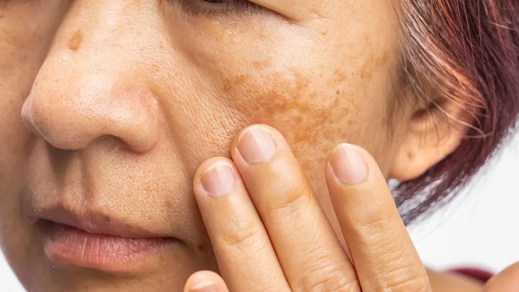 تاثیر اشعه های مضر نور خورشید بر روی پوست