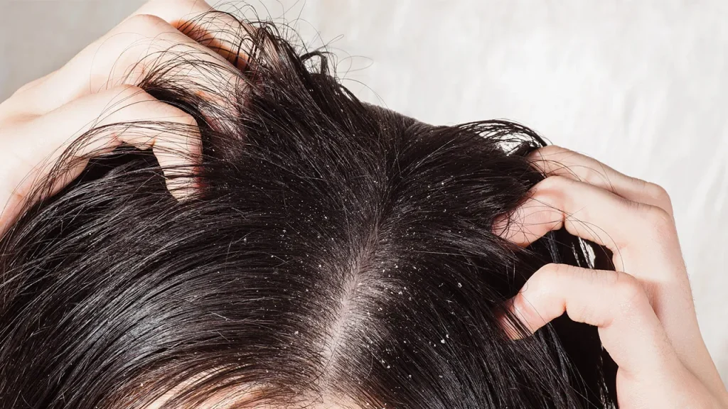 مهار شوره سر با روغن درخت چای