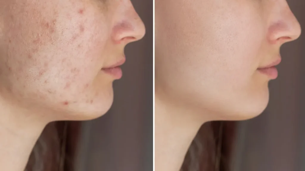 روشن تر شدن پوست با استفاده از نیاسینامید