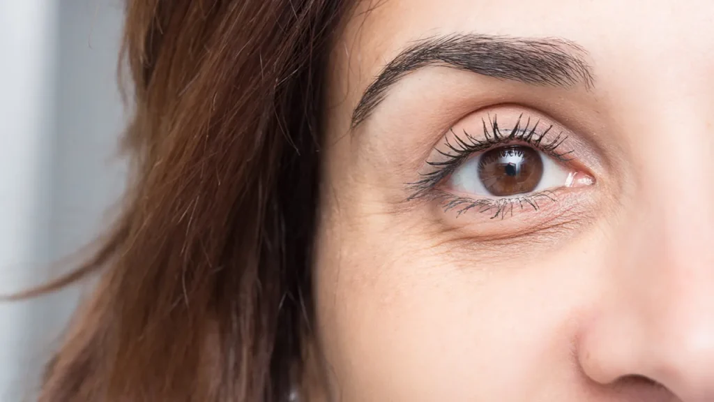 تیرگی و پف زیر چشم